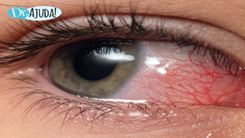 Coceira ocular afeta cerca de 40% da população em algum momento da vida, mas nem toda sensação nos olhos é realmente coceira